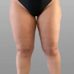 Lipödem Nedir? Nasıl Tedavi Edilir? 6 lipodem-izmir