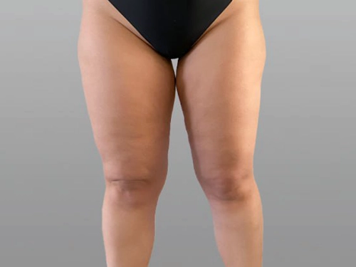 Lipödem Nedir? Nasıl Tedavi Edilir? 1 lipodem-izmir